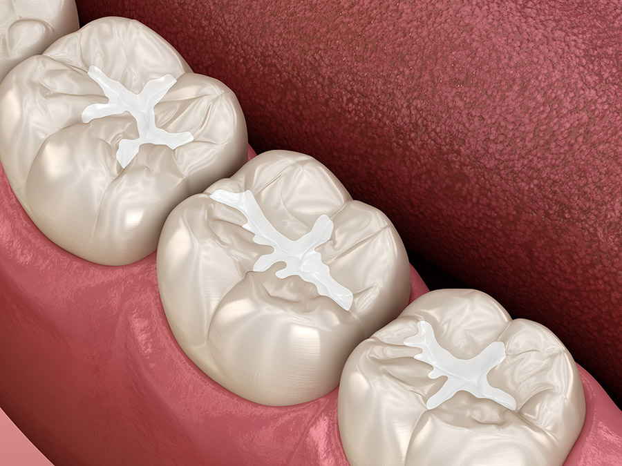 Composite Fillings in Boston