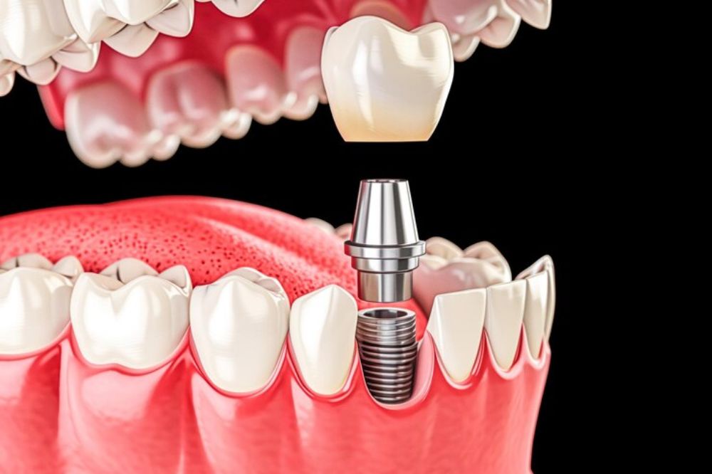 dental implants near you